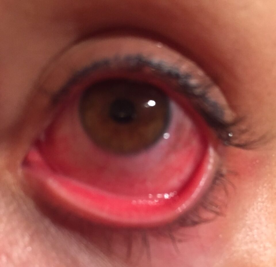 Viral conjunctivitis – redness of conjunctiva, a mild discharge.