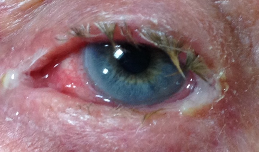 Bacterial conjunctivitis – not redness of the eye along with yellow, sticky eyelashes. The image represents conjunctivitis with blepharitis.