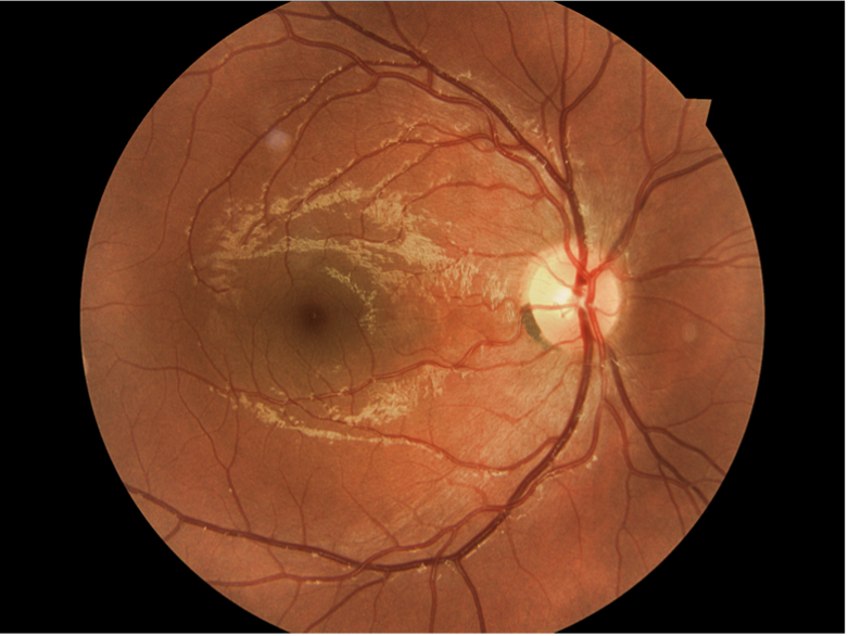 Fundus image (right eye) of a 15-year-old who is interested in wearing contact lenses.